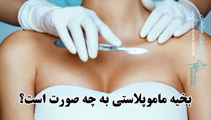 بخیه ماموپلاستی به چه صورت است؟