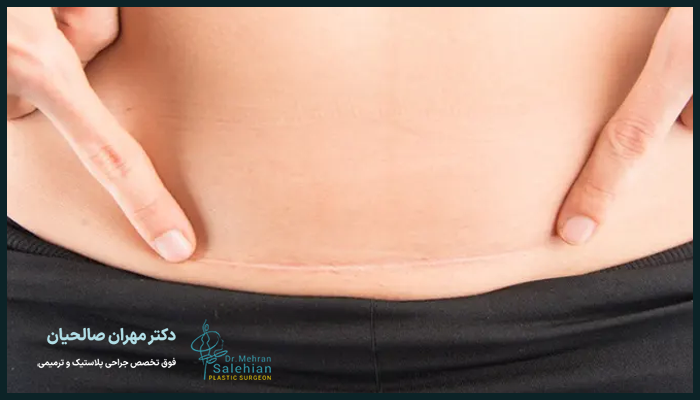 جراحی مینی ابدومینوپلاستی چیست؟