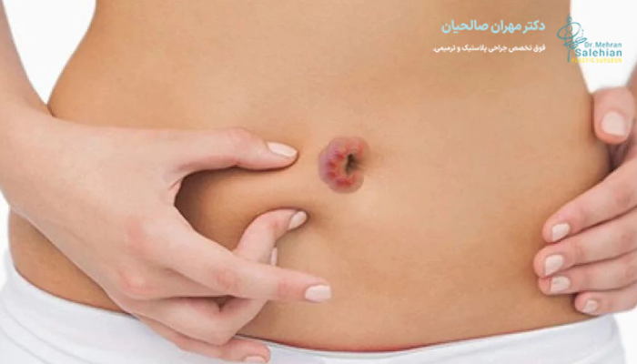 چگونه از عفونت ناف پس از ابدومینوپلاستی پیشگیری کنیم؟