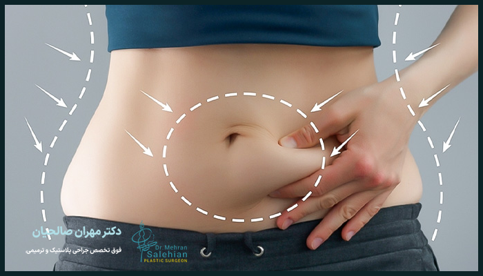علل تجمع مایع بعد از عمل ابدومینوپلاستی
