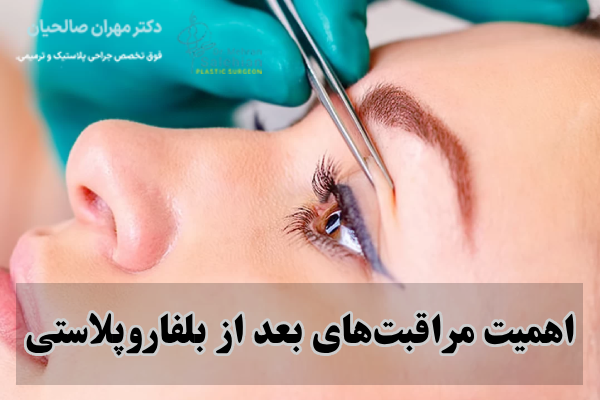 اهمیت مراقبت‌های بعد از بلفاروپلاستی
