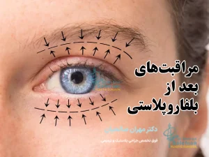 مراقبت های بعد از بلفاروپلاستی
