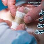 عمل بینی بدون تامپون