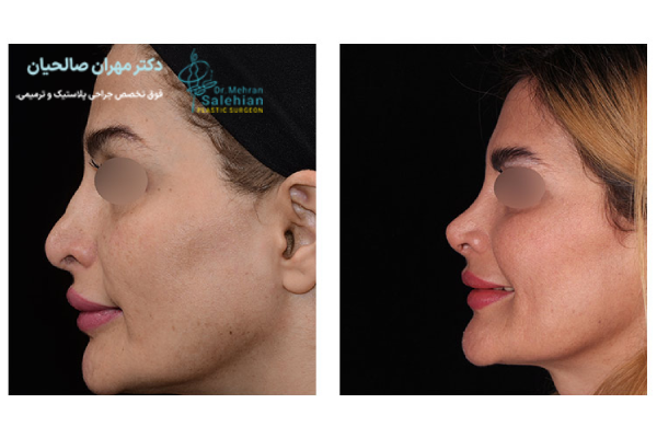 ارتجاعی بودن پوست بینی در جراحی ثانویه بینی