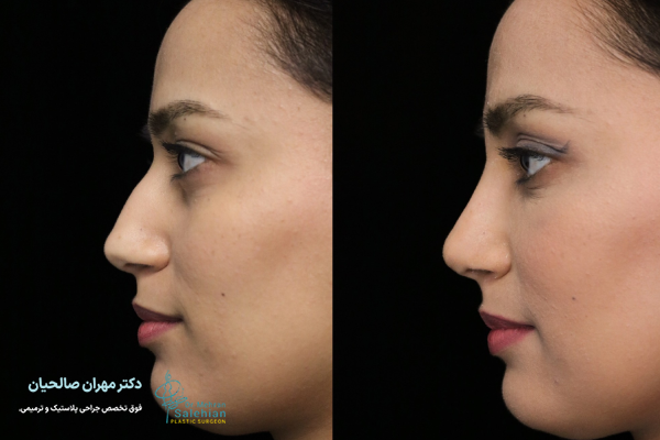جراحی بینی طبیعی چه ویژگی‌هایی دارد؟