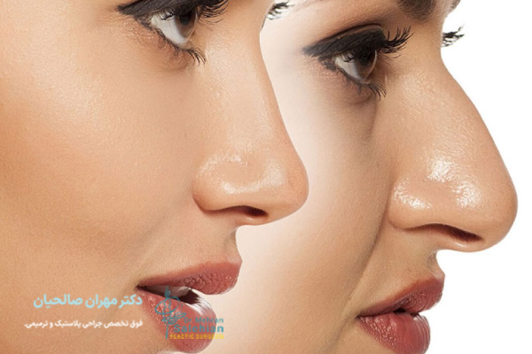 ساختار بینی غضروفی