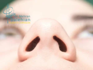 عدم تقارن سوراخ‌های بینی