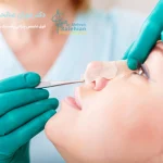 عمل بینی غضروفی
