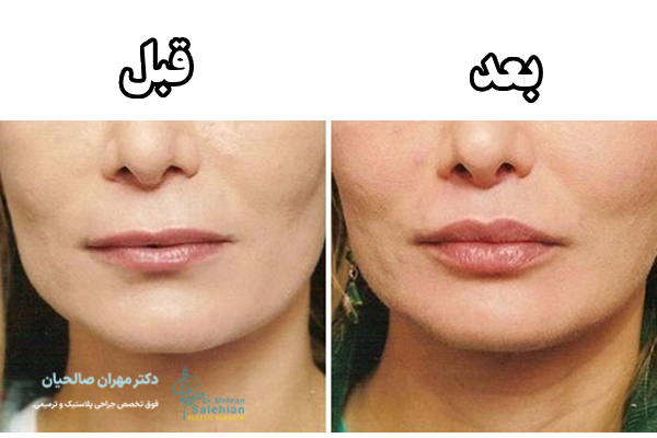عکس قبل و بعد لیفت سانترال لب
