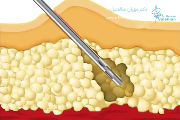 تفاوت ابدومینوپلاستی با لیپوماتیک در محل جراحی و نوع بخیه‌ها