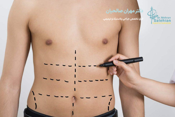 تفاوت ابدومینوپلاستی با لیپوماتیک