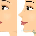جراحی بینی عروسکی: زیبایی فراتر از واقعیت