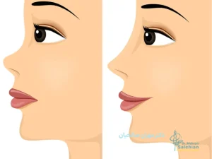 جراحی بینی عروسکی: زیبایی فراتر از واقعیت