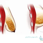 جراحی لیفت سینه؛ درمان افتادگی سینه