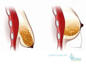جراحی لیفت سینه؛ درمان افتادگی سینه