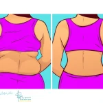 جراحی لیفت کمر؛ راهی برای زیبایی و فرم دهی به نیم تنه پایینی
