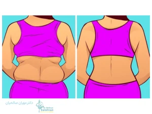 جراحی لیفت کمر؛ راهی برای زیبایی و فرم دهی به نیم تنه پایینی