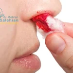 خونریزی بعد از عمل بینی