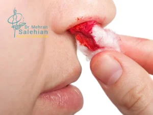 خونریزی بعد از عمل بینی