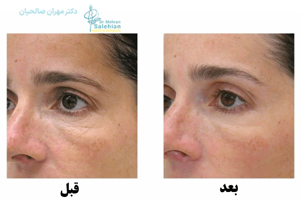 مزایای مزوتراپی پوست