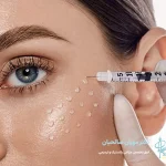 مزوتراپی پوست: پیشگیری از چین و چروک‌ها!
