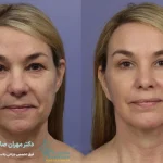 عدم تقارن بعد از لیفت صورت-شاخص