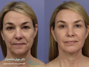 عدم تقارن بعد از لیفت صورت-شاخص