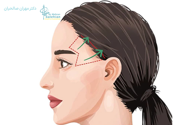 لیفت شقیقه با تزریق بوتاکس چقدر ماندگاری دارد؟